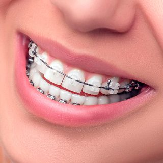 img-ortho-braces-ceramic