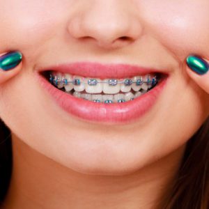 braces-dexter