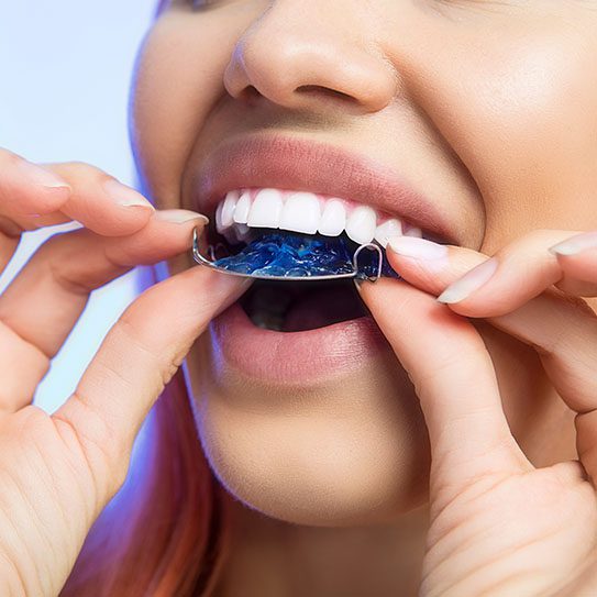 retainers retention